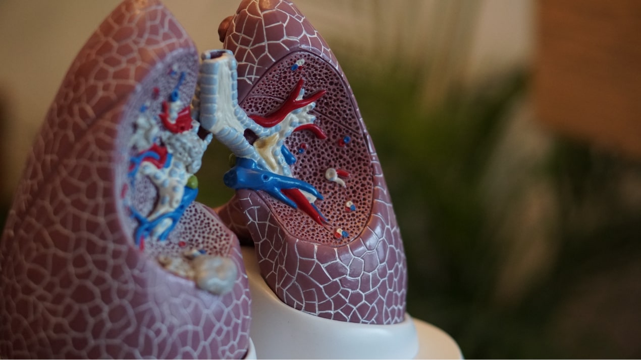 Efficacy and Safety of Sequential Amoxicillin-Clavulanate in the Treatment of Anaerobic Lung Infections
